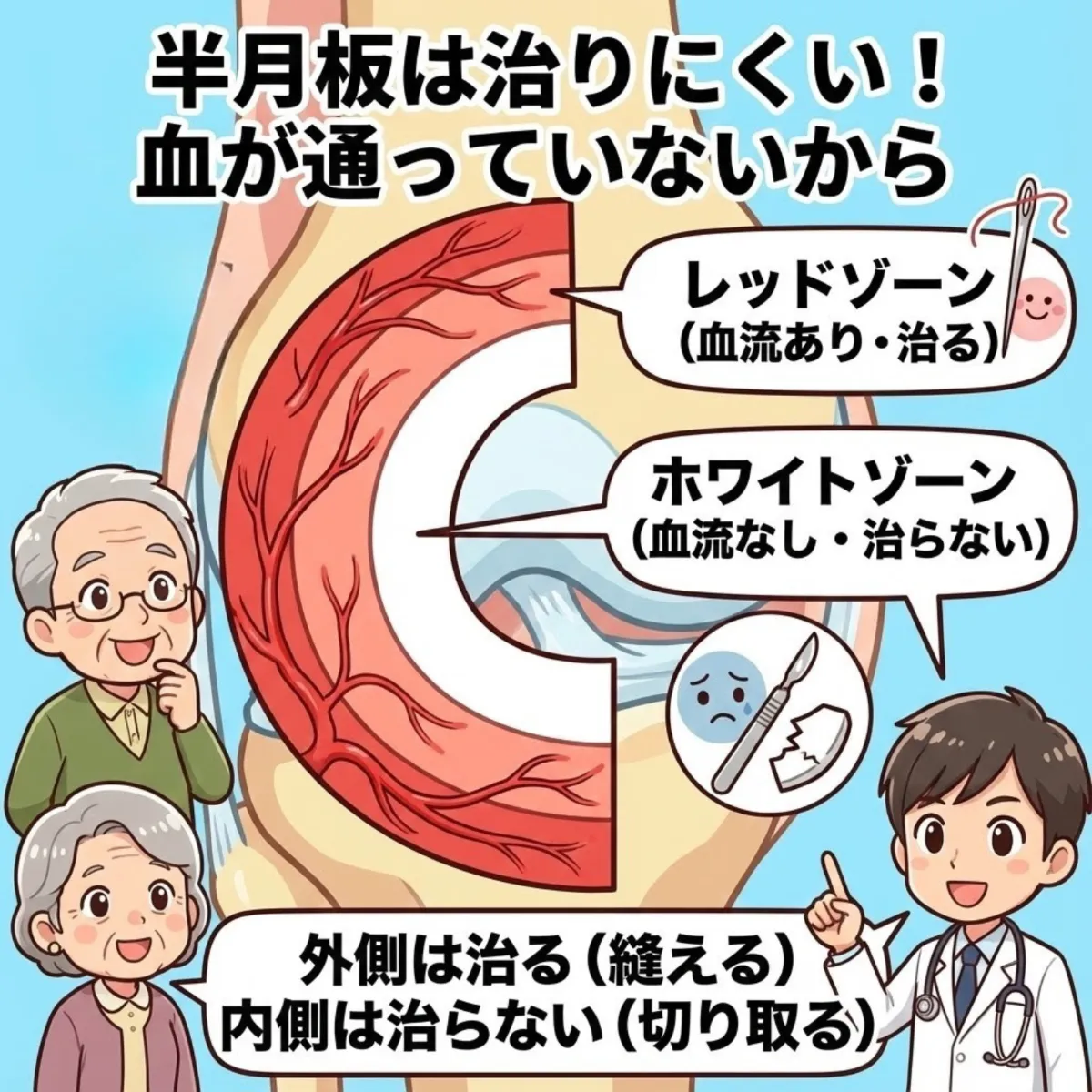半月板損傷・断裂に特化した再生医療（幹細胞治療）：手術で「切り取ら