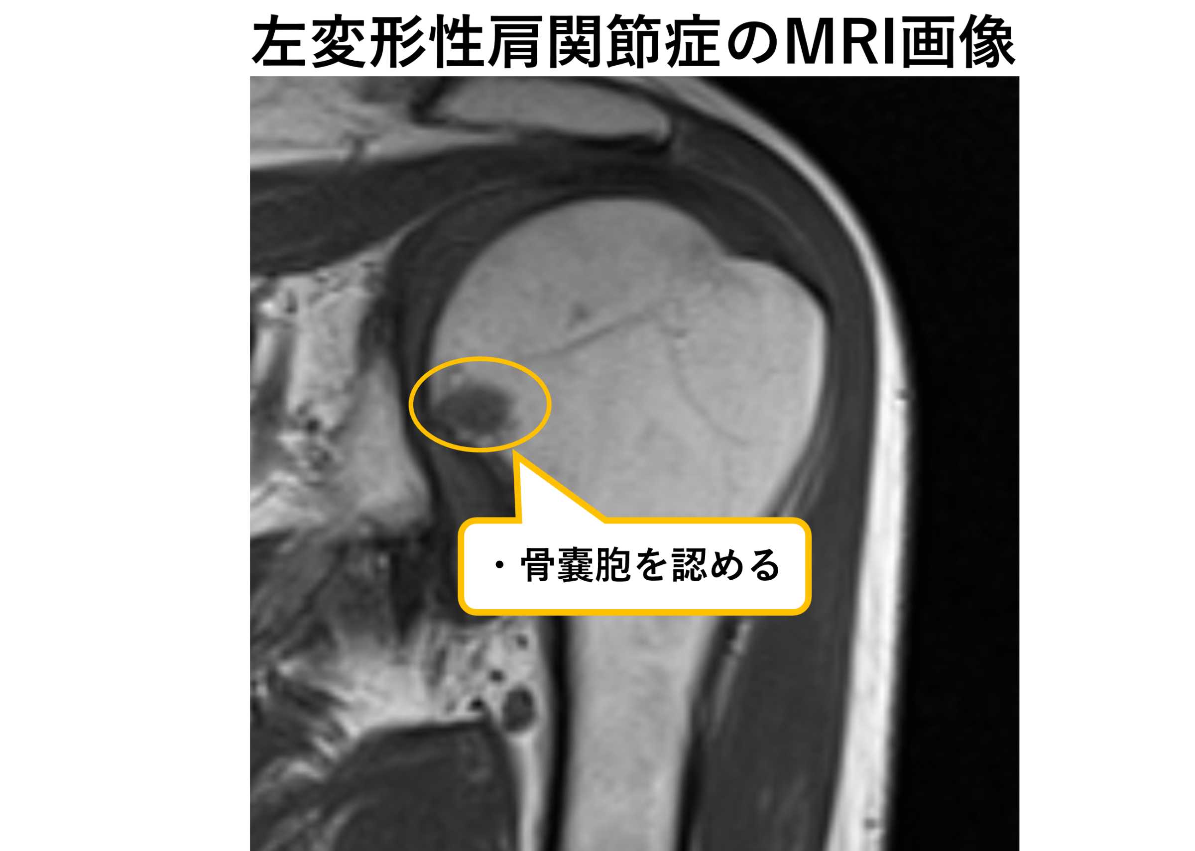 肩関節のMRI 裁断済み 凍結肩/肩関節周囲炎のMRI画像所見のポイント！