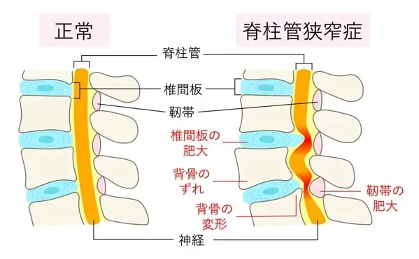 脊柱管狭窄症、坐骨神経、腰椎椎間板ヘルニア 脊柱管狭窄症と椎間板ヘルニアによる坐骨神経痛の為に生活が困難