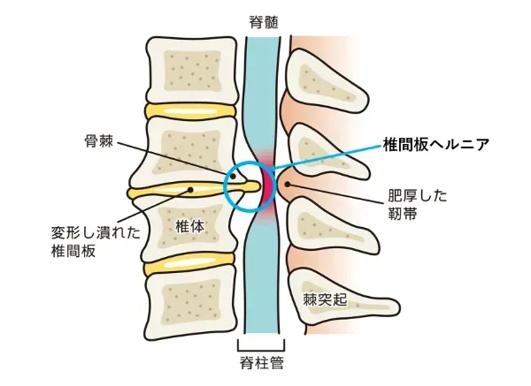 脊柱管狭窄症、坐骨神経、腰椎椎間板ヘルニア 脊柱管狭窄症と椎間板ヘルニアによる坐骨神経痛の為に生活が困難