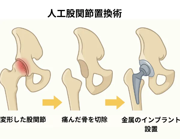 医師解説】人工股関節置換術で「後悔」したくない人へ。知っておくべき