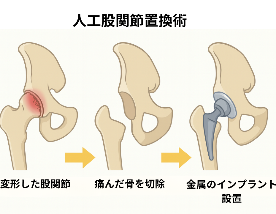 医師解説】人工股関節置換術で「後悔」したくない人へ。知っておくべき