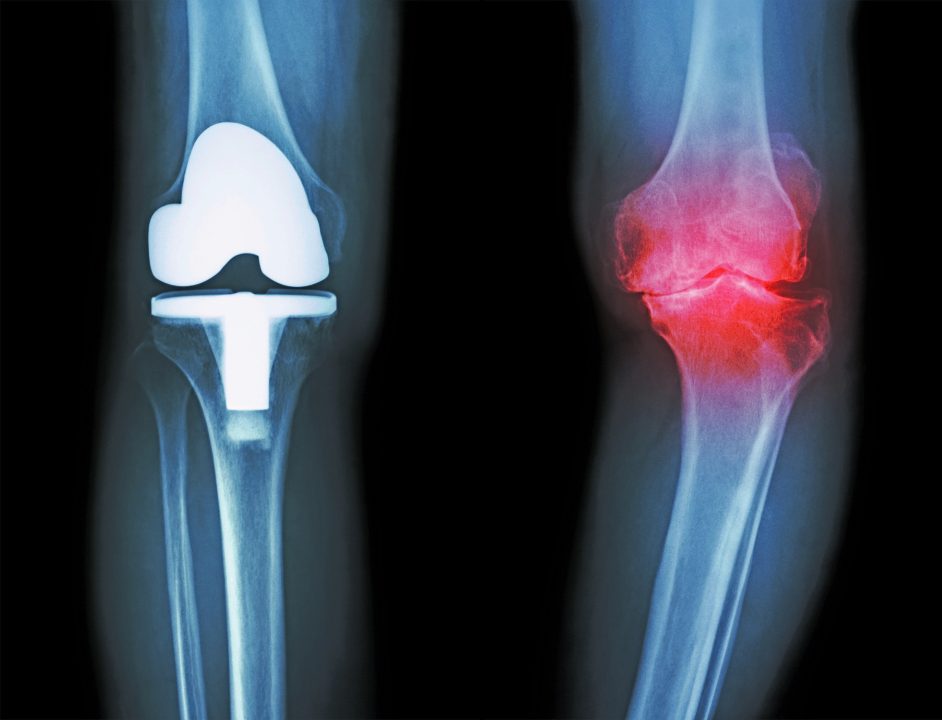 人工膝関節置換術とは？術後や費用まで医師が徹底解説！