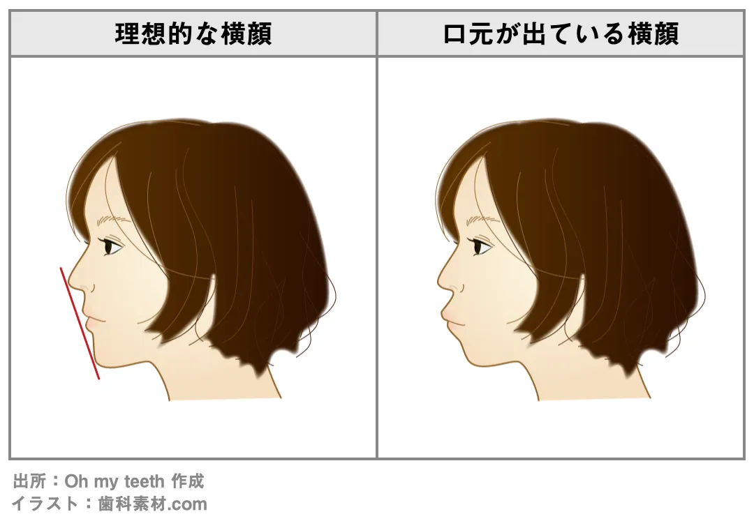 抜歯矯正は口元が引っ込みすぎる 歯科矯正で口元が下がりすぎるケースとは 歯科矯正ブログ マウスピース矯正 Oh My Teeth