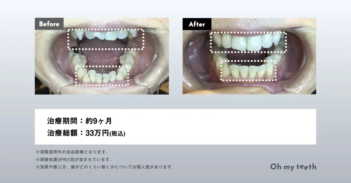 2025年最新】歯科矯正メカニクスの人気アイテム - メルカリ