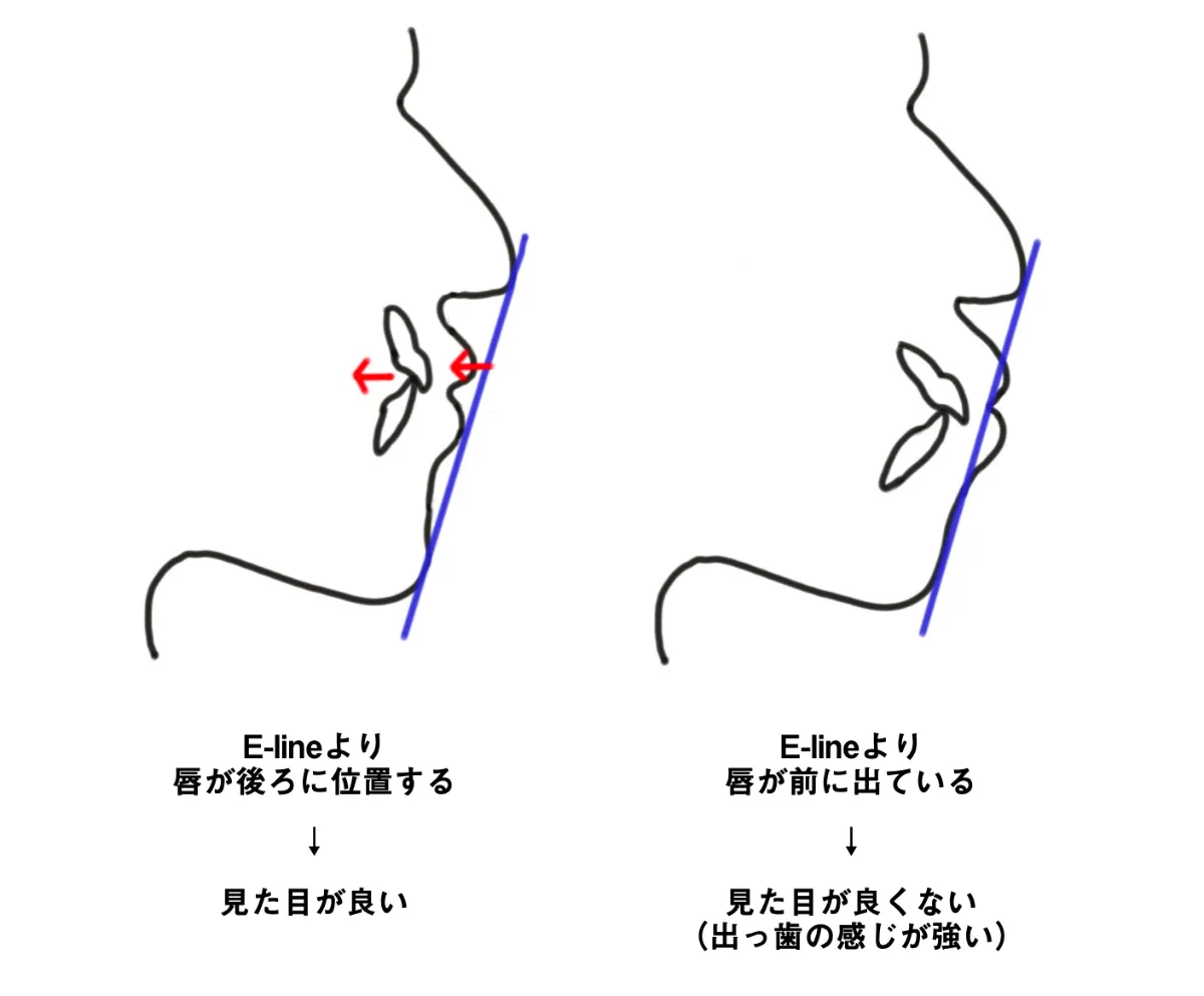 歯学博士が解説 出っ歯で突出した口元 口ボゴ はマウスピース矯正でなおせる 自宅でマウスピース矯正 Oh My Teeth