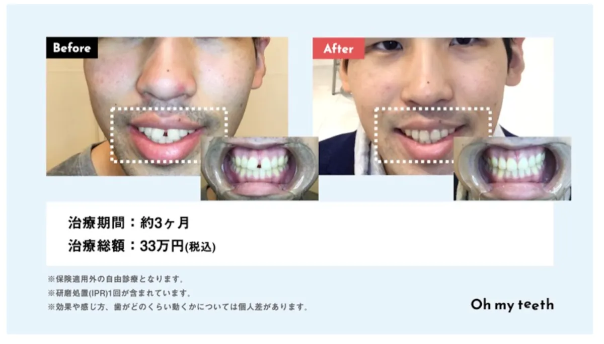 マウスピース矯正ですきっ歯は治せる 効果 値段 治し方を解説 歯科矯正ブログ マウスピース矯正 Oh My Teeth