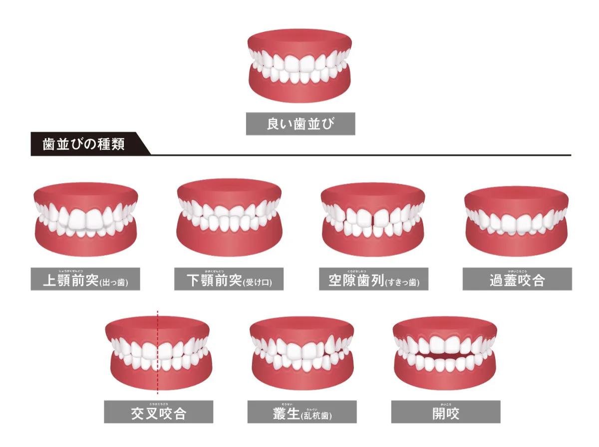 歯並びが悪い原因と放置するリスク 歯科矯正ブログ マウスピース矯正 Oh My Teeth
