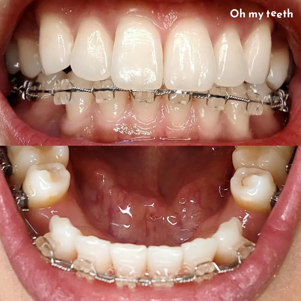 忙しい大人向け歯科矯正方法とは 種類 費用 相場 期間別に比較 自宅でマウスピース矯正 Oh My Teeth