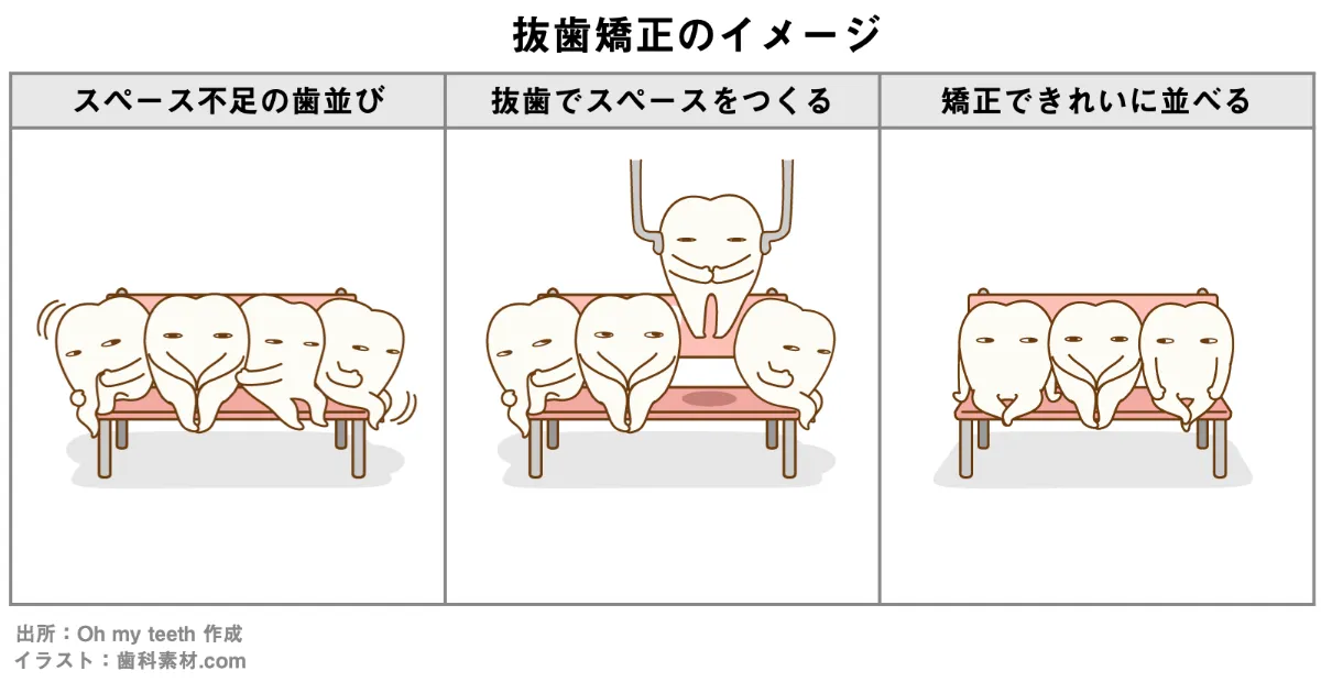 歯科矯正で抜歯するのはこんな時 流れや何本抜くのかも解説 歯科矯正ブログ マウスピース矯正 Oh My Teeth