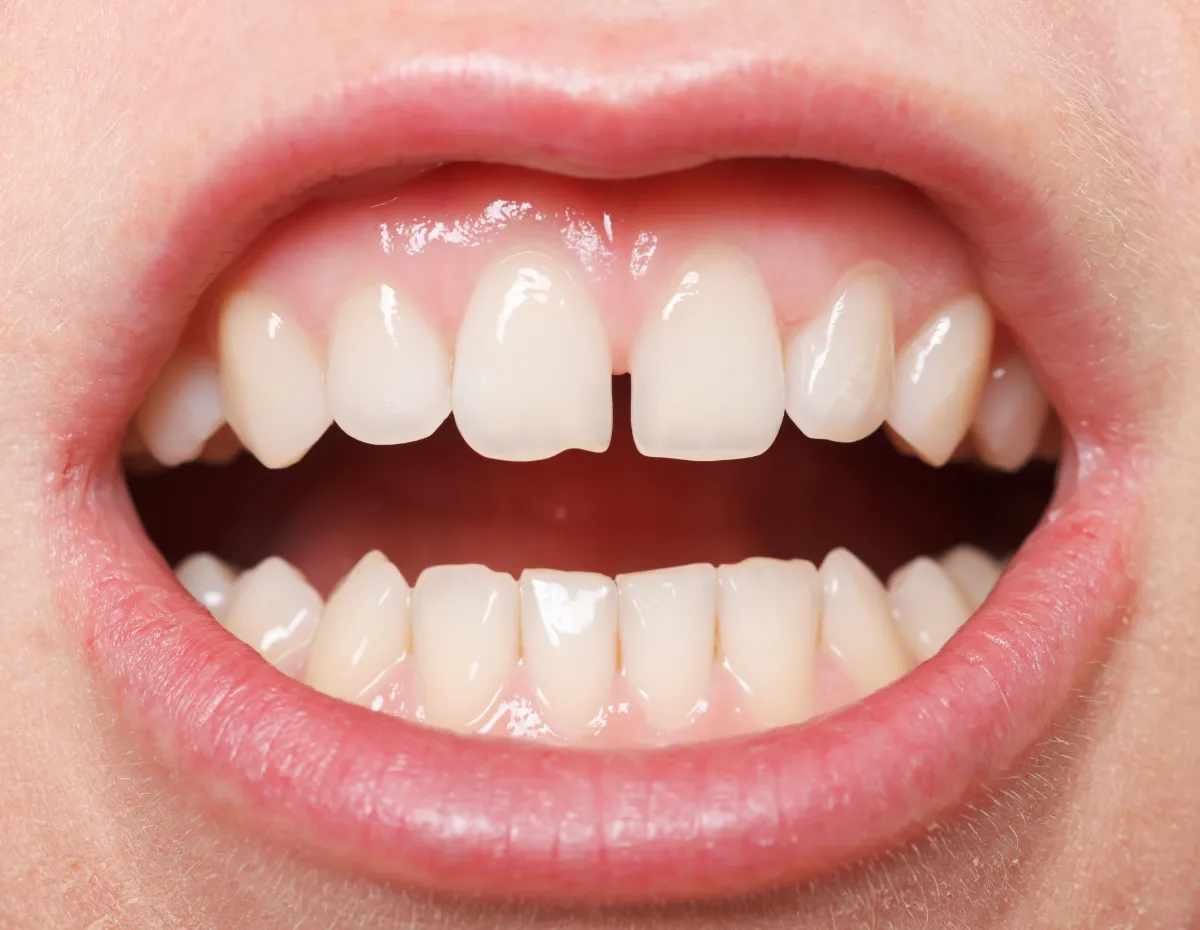 前歯の隙間を埋める5つの方法！原因や予防策も解説  歯科矯正ブログ - マウスピース矯正 Oh my teeth