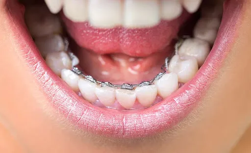 中学生 高校生の歯の矯正の値段は ワイヤー マウスピースそれぞれで紹介 歯科矯正ブログ マウスピース矯正 Oh My Teeth