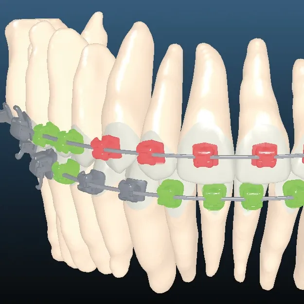 インシグニア矯正のブラケットポジションを示すソフト