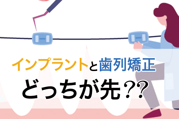 インプラントと歯列矯正はどっちを先に始めた方がいい？