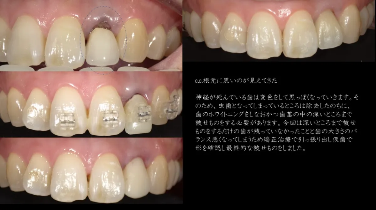 最低価格の 審美歯科（セレック）| 医療法人 歯科ハミール 歯科学