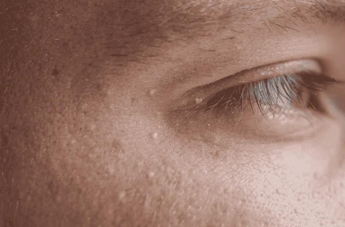 ダーマペンでも注目を浴びたエクソソームと幹細胞培養液の違い#美容 #ダーマペン4 #美容皮膚科 #エクソソーム | TikTok, image size:1126x742