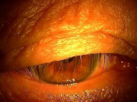 眼瞼挙筋前転術_手術前