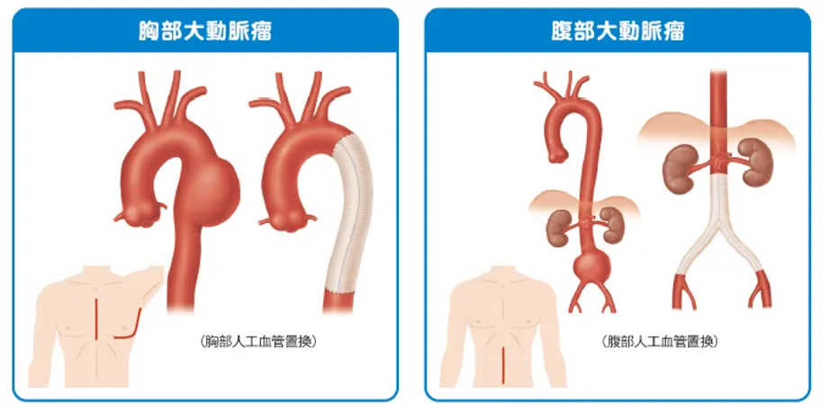 【裁断済】大動脈疾患の手術 大動脈疾患の手術 心臓血管外科エクセレンス 4_裁断済み 大動脈