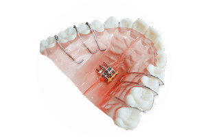 メタルボンド | 東京の自費技工専門歯科技工所 | ケン・デンタリックス