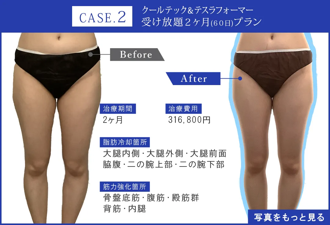脂肪冷却 脂肪冷却痩身｜メスも針も使わない、リバウンドの少ない医療痩身