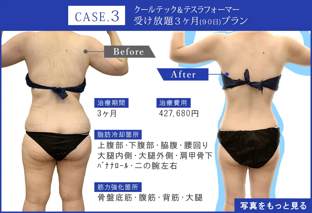 脂肪冷却③ 業務用脂肪冷却痩身マシン 3Dサラウンドクライオ – 美容機器 卸