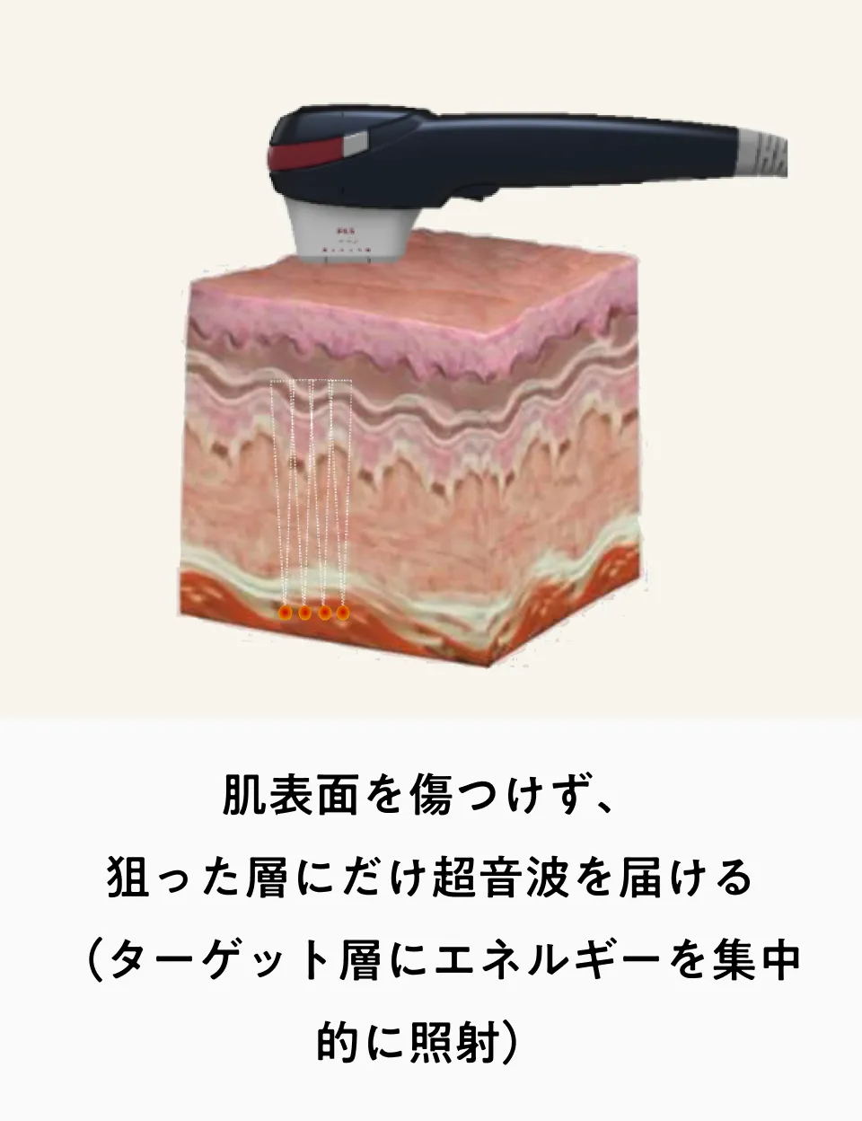 フェイスリフト超音波 フェイスリフト超音波