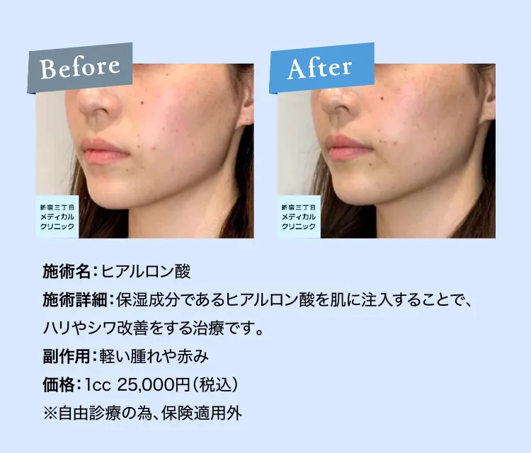 ぬこさん専用ウィルピュア　ヒアルロン酸　三個 ヒアルロン酸 | 新宿三丁目メディカルクリニック