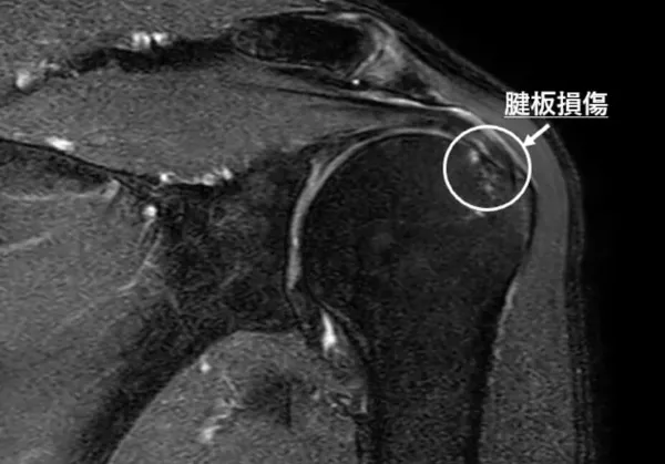 肩のMRI画像