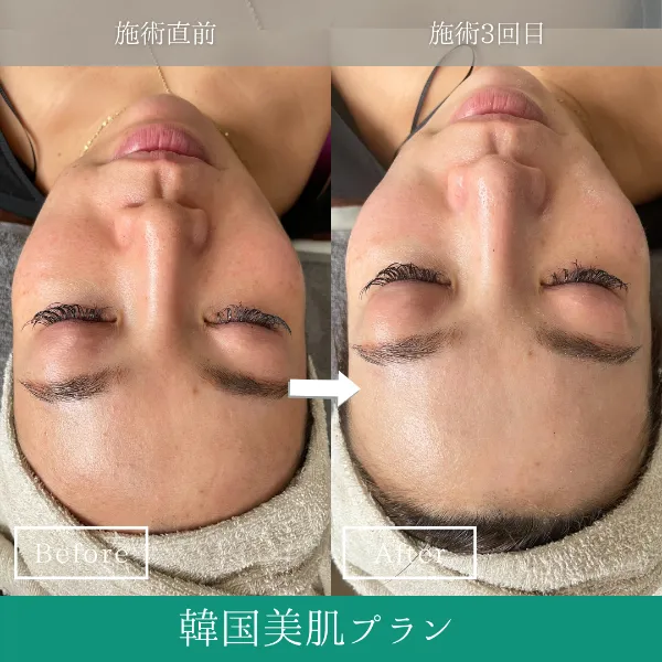 REVI ハーブピーリング 20回 REVIハーブピーリング | 毛穴ケアサロン】Lavi Aromatic Herb