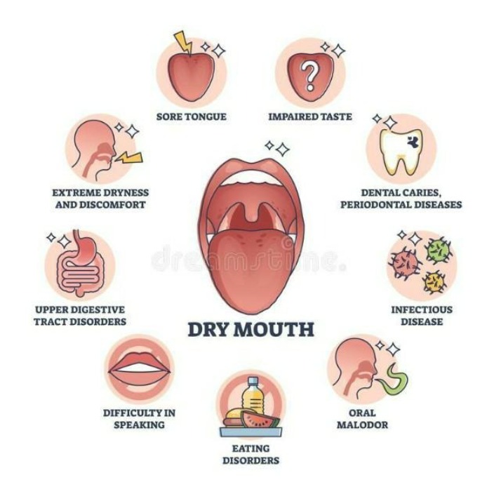 Xerostomia (Dry Mouth) and Salivary Glands - Outline Diagram