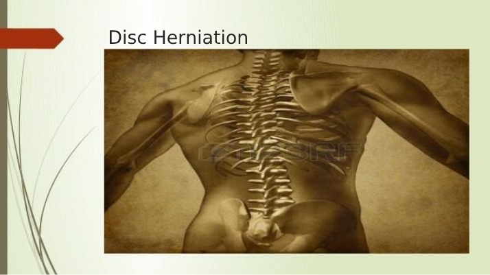 Disc Herniation - Causes, Symptoms, and Treatment