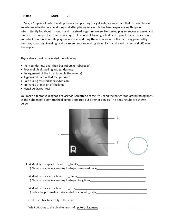 Osgood-Schlatter Disease as a Common Cause of Knee Pain