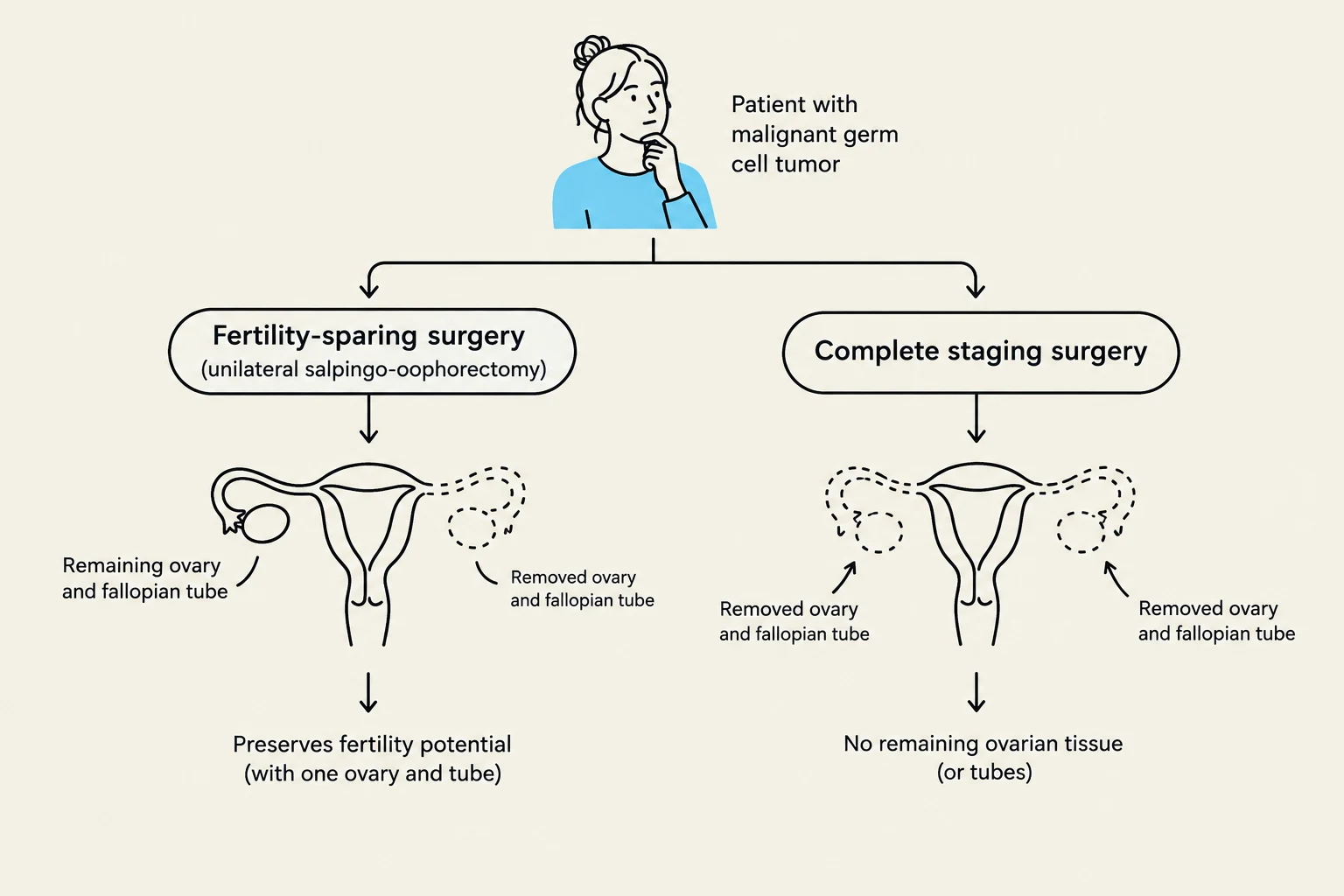 This diagram illustrates two surgical approaches for a patient with a malignant germ cell tumor: fertility-sparing surgery, which preserves one ovary and fallopian tube to maintain fertility potential, and complete staging surgery, which removes all ovarian tissue and tubes, resulting in no remaining ovarian tissue.