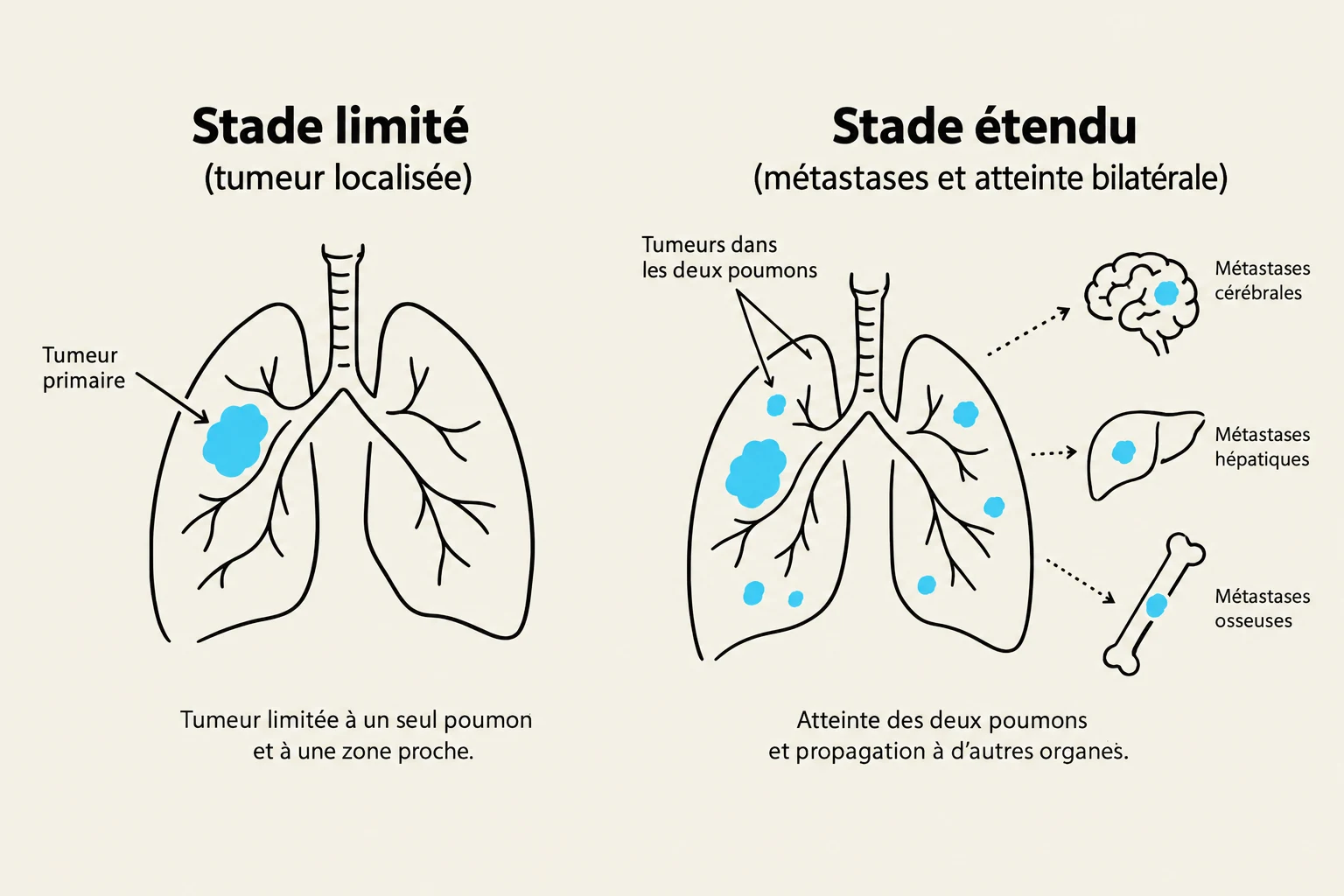 Diagram illustrating the progression of lung cancer from a localized tumor to widespread metastases in other organs.