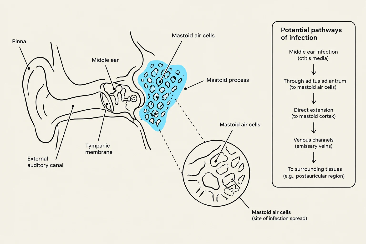 Diagram illustrating the anatomy of the ear and potential pathways of infection, including the mastoid air cells.