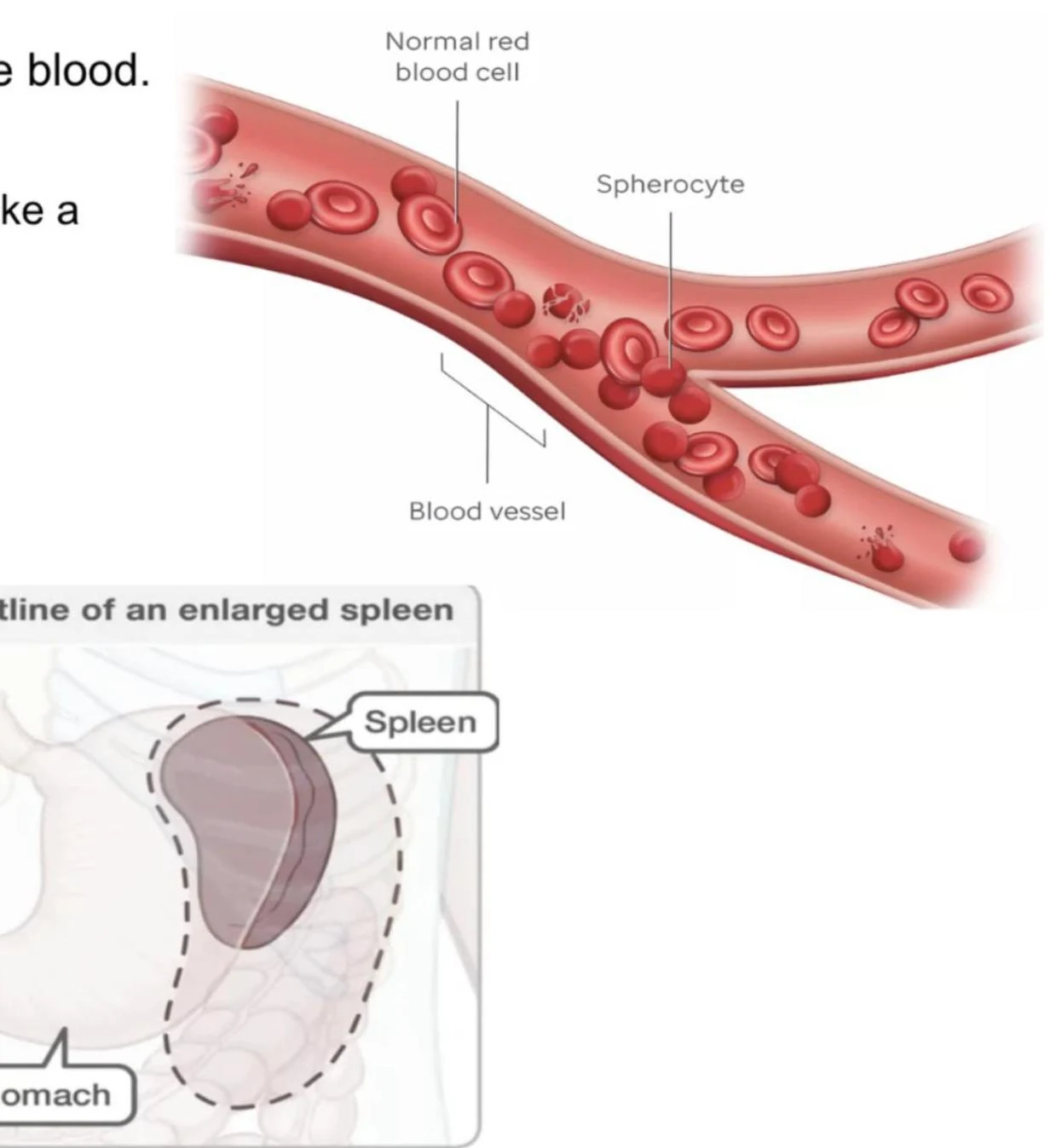 Illustration showing normal red blood cells and spherocytes within a blood vessel, alongside a diagram of an enlarged spleen and stomach.