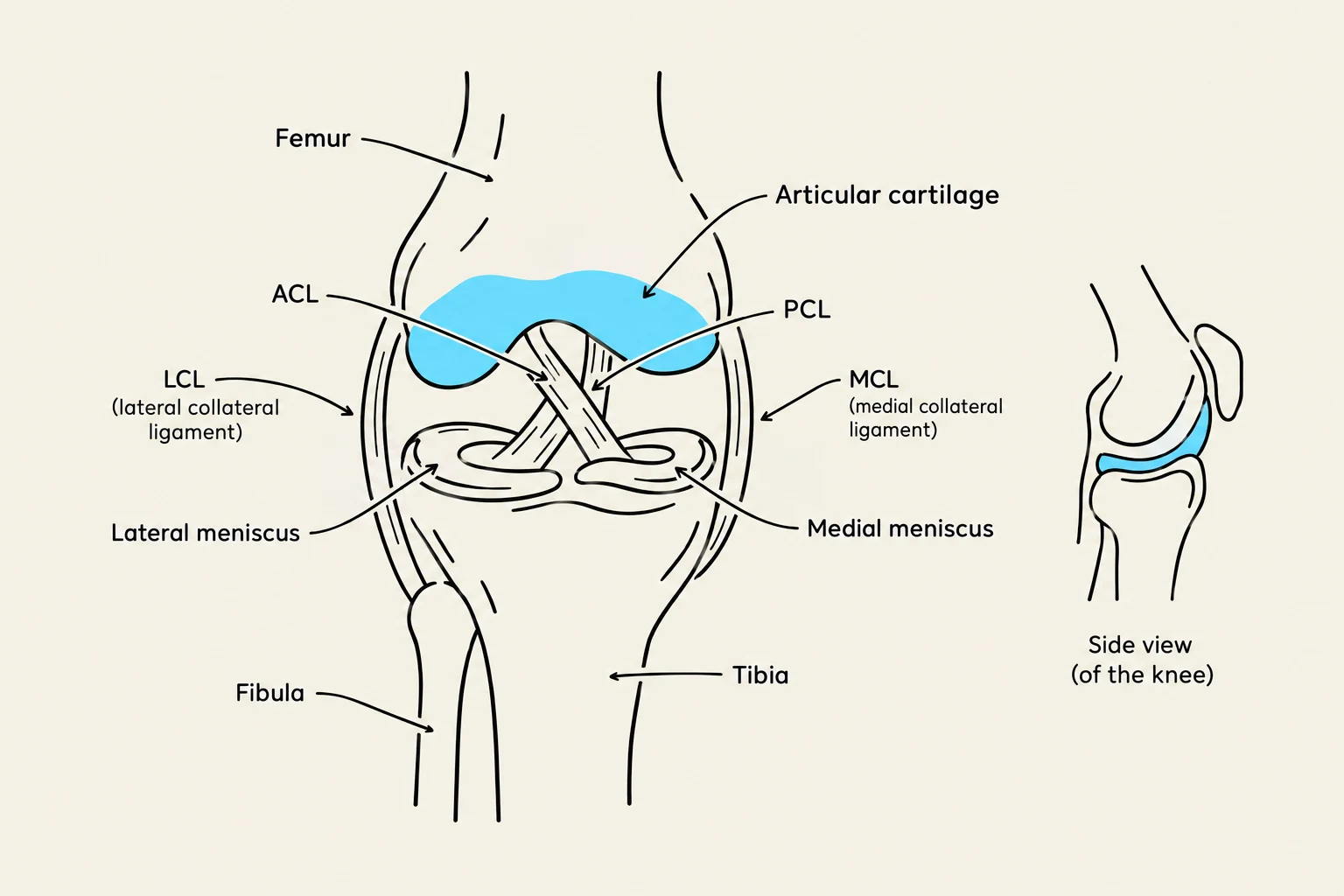 An illustration of the human knee joint, showing the femur, tibia, fibula, articular cartilage, ACL, PCL, MCL, LCL, and menisci.
