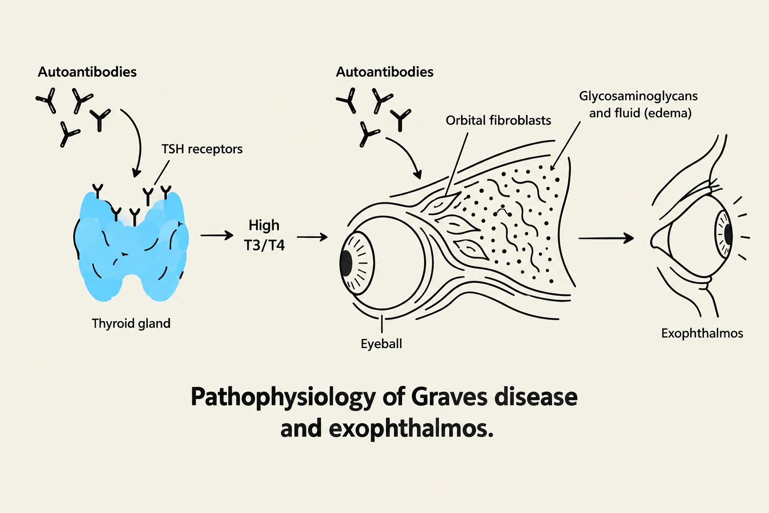 This diagram illustrates the pathophysiology of Graves disease and exophthalmos, showing how autoantibodies affect the thyroid gland and lead to changes in the eyeball.