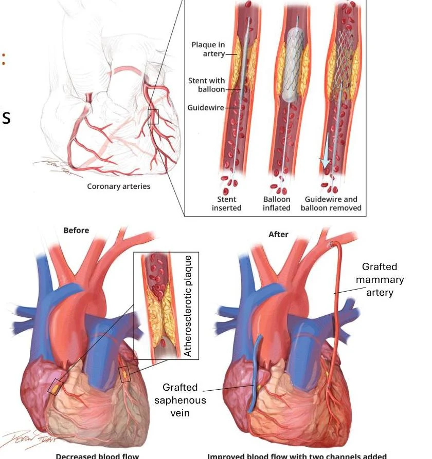 Diagrams illustrating coronary artery disease and surgical interventions, including angioplasty with stenting and bypass surgery using grafted saphenous vein and mammary artery.