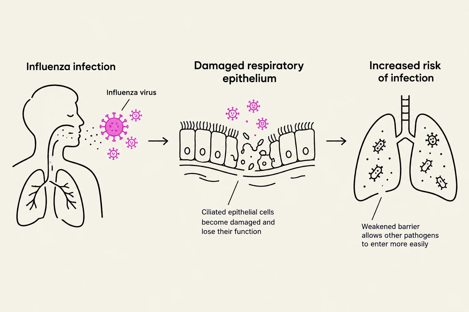 Diagram illustrating the progression of influenza infection, from initial viral entry and damage to respiratory epithelium, to an increased risk of secondary infections.