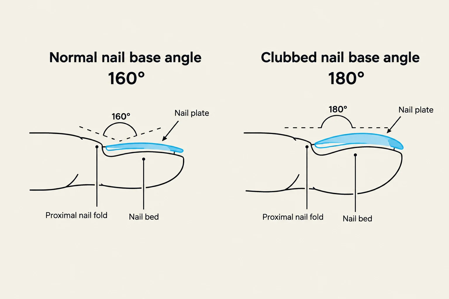 Diagrams illustrating the difference between a normal nail base angle of 160 degrees and a clubbed nail base angle of 180 degrees, showing the nail plate, proximal nail fold, and nail bed.