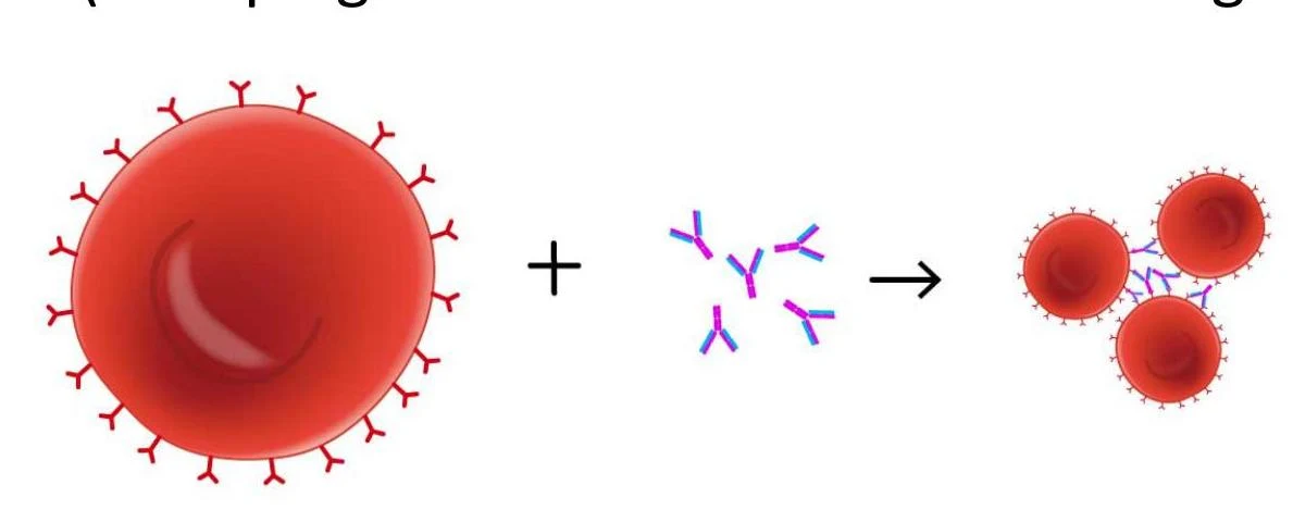 Illustration showing red blood cells aggregating due to antibodies.