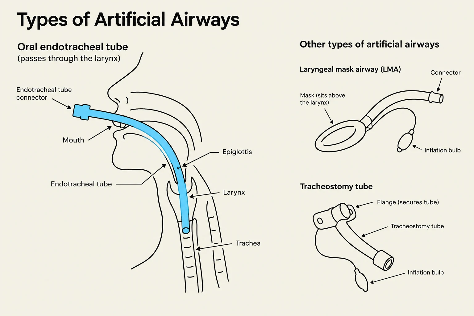 Diagrams illustrating different types of artificial airways: oral endotracheal tube, laryngeal mask airway (LMA), and tracheostomy tube.