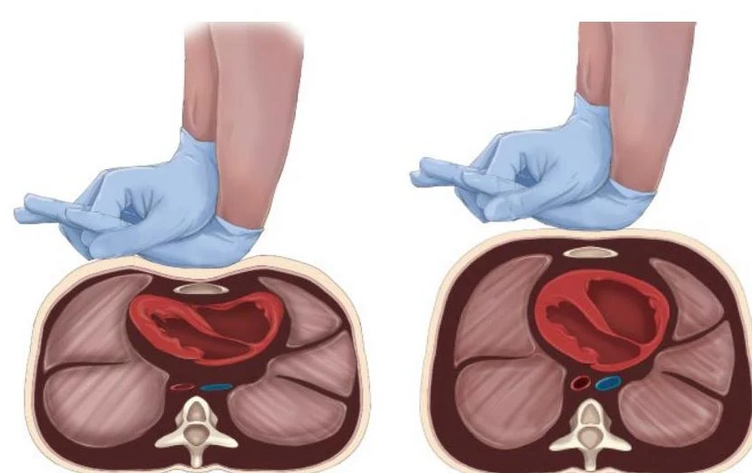 Diagram illustrating two different hand positions for chest compressions on a cross-section of the human torso, highlighting the heart.