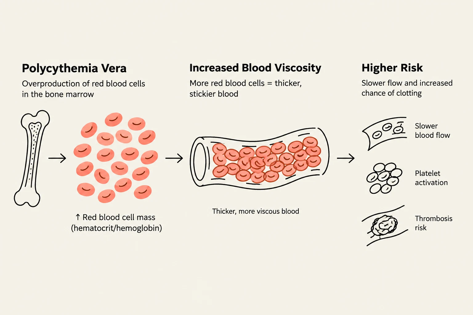 This diagram illustrates the pathophysiology of Polycythemia Vera, showing how overproduction of red blood cells leads to increased blood viscosity, slower blood flow, platelet activation, and a higher risk of thrombosis.