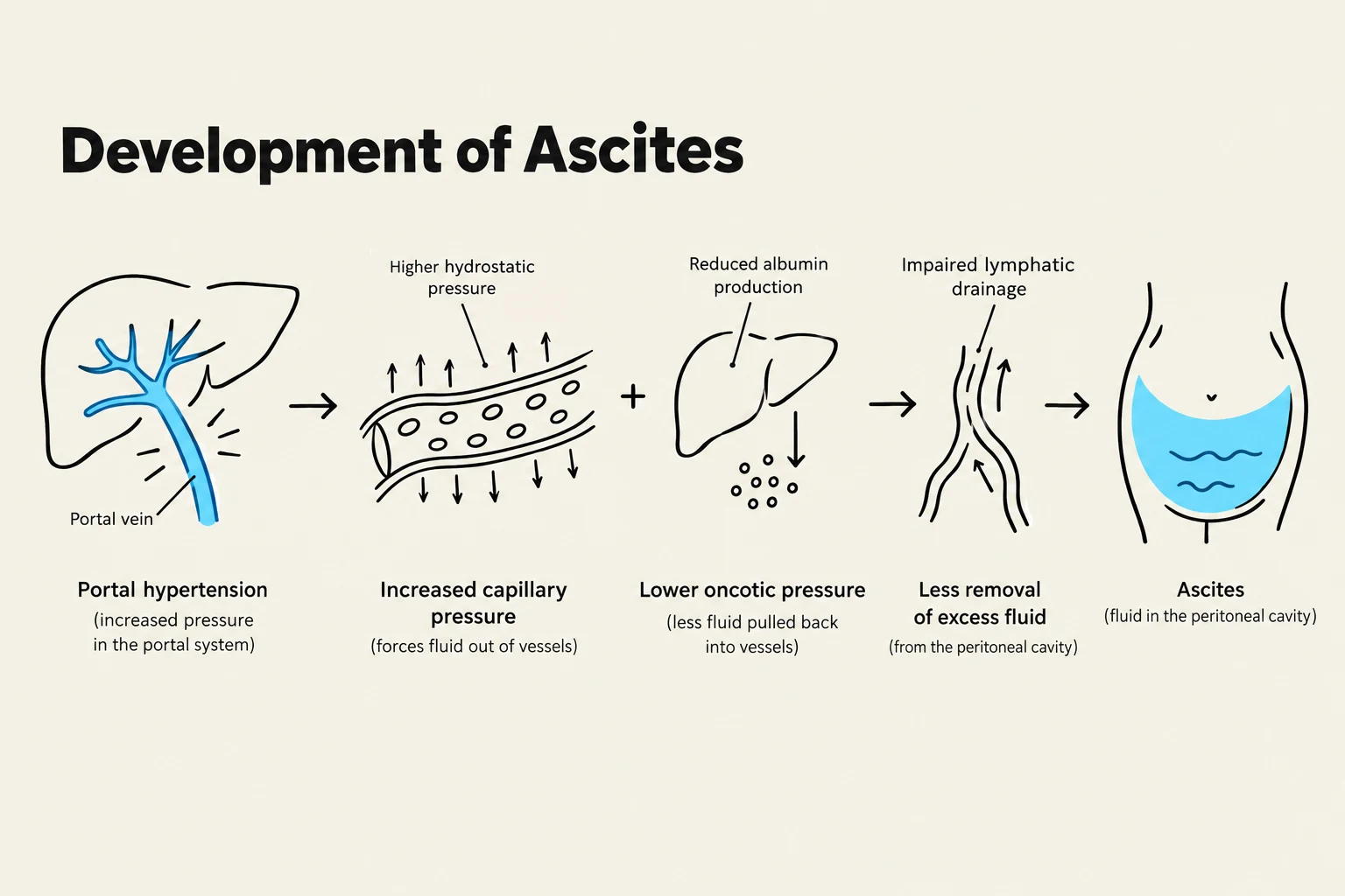 Diagram illustrating the development of ascites, a condition characterized by fluid accumulation in the peritoneal cavity, due to factors like portal hypertension, increased capillary pressure, reduced albumin production, and impaired lymphatic drainage.