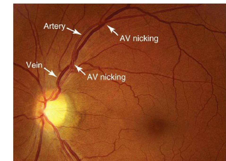 This image shows a fundus photograph of the retina, illustrating arteries, veins, and the phenomenon of AV nicking, which is a sign of hypertensive retinopathy.