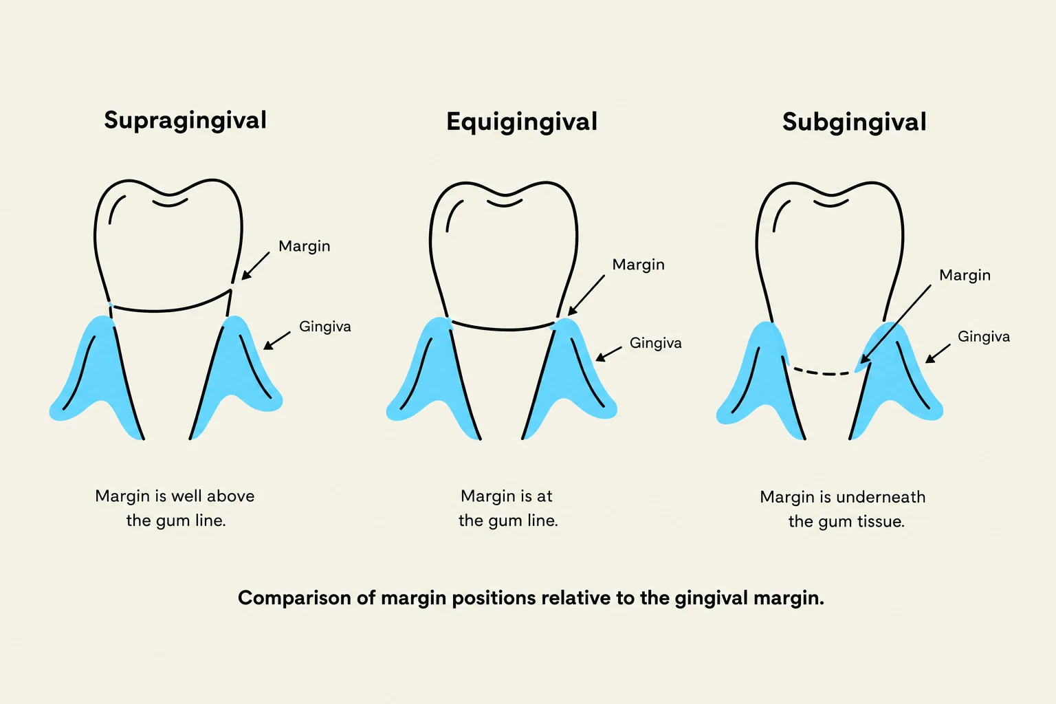 Comparison of margin positions relative to the gingival margin.