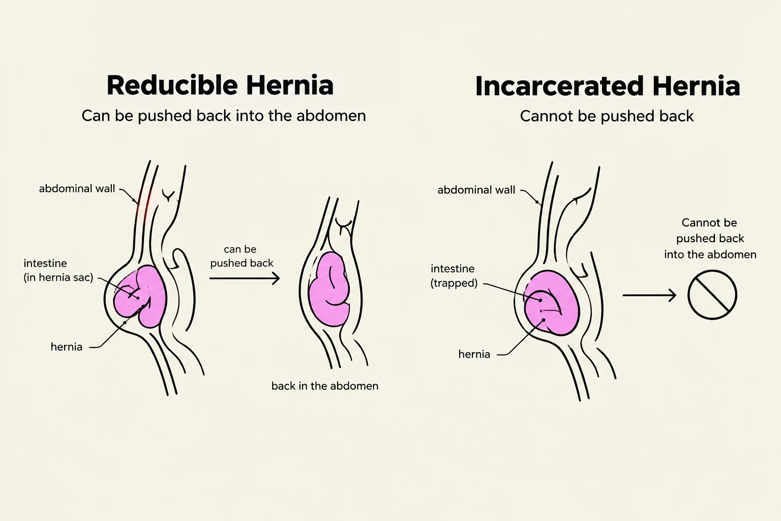 Diagrams illustrating the difference between a reducible hernia, where the intestine can be pushed back into the abdomen, and an incarcerated hernia, where it cannot.