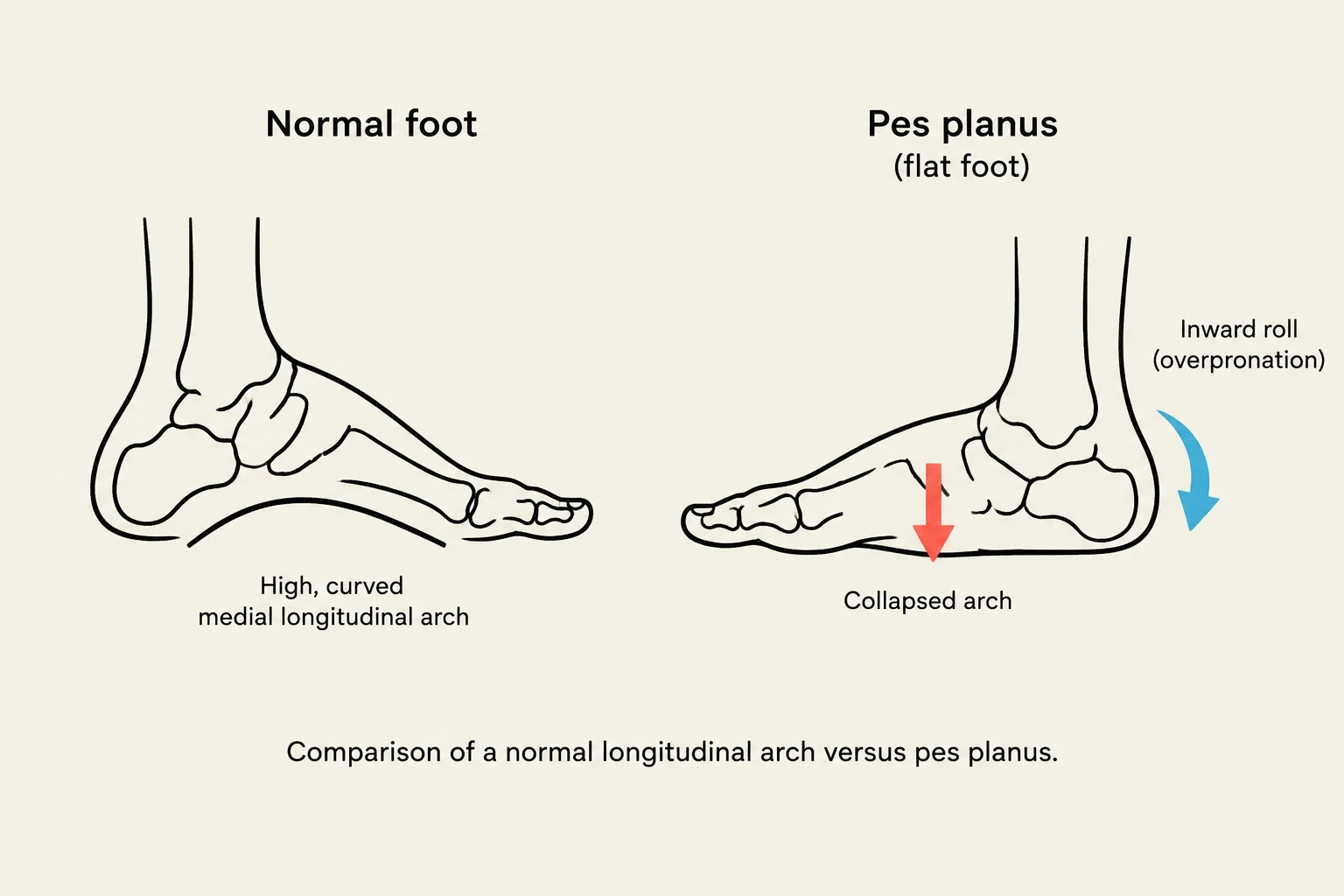 Comparison of a normal longitudinal arch versus pes planus (flat foot), illustrating a collapsed arch and inward roll (overpronation).